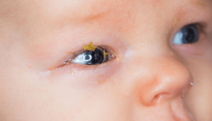 mắt trẻ sơ sinh bị ghèn