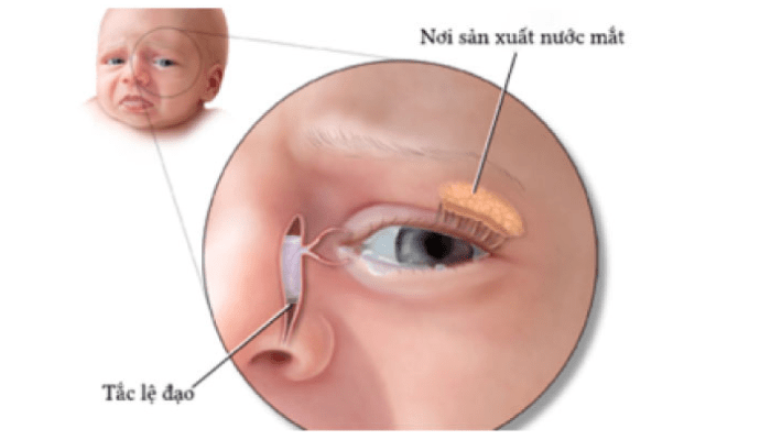 cách làm sạch ghèn mắt cho trẻ sơ sinh