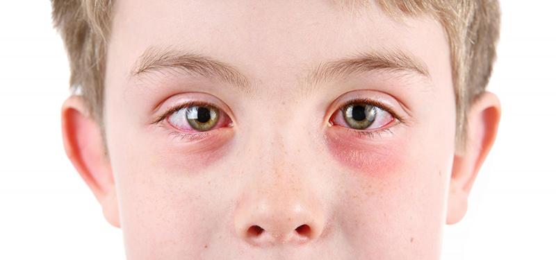 viêm kết mạc mắt ở trẻ em