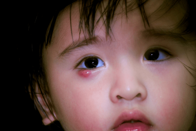 các bệnh về mắt ở trẻ em