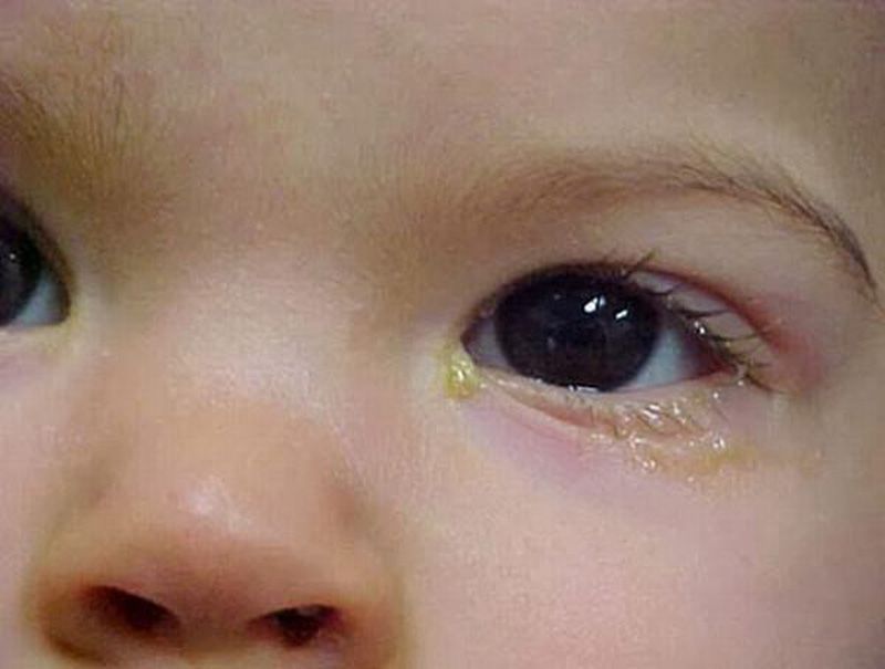 cách mát-xa mắt cho trẻ bị tắc tuyến lệ
